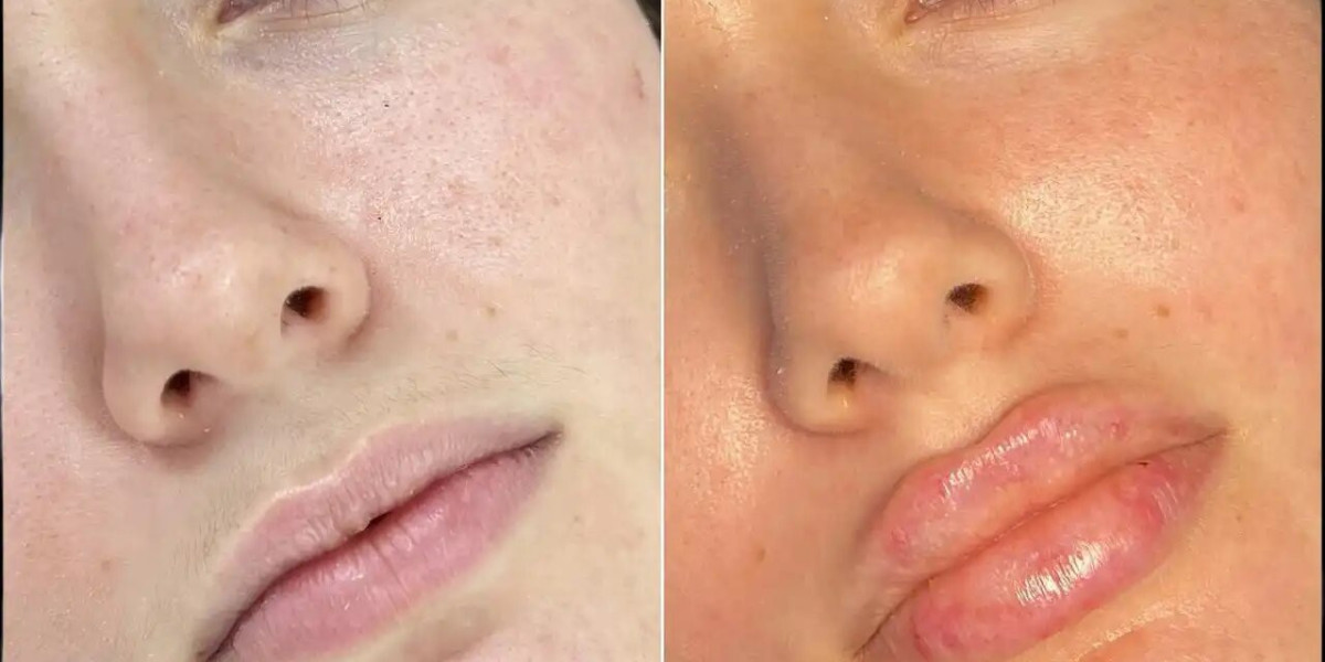 Best Plastic Surgeon in dubai for Fillers: How to Avoid Common Side Effects