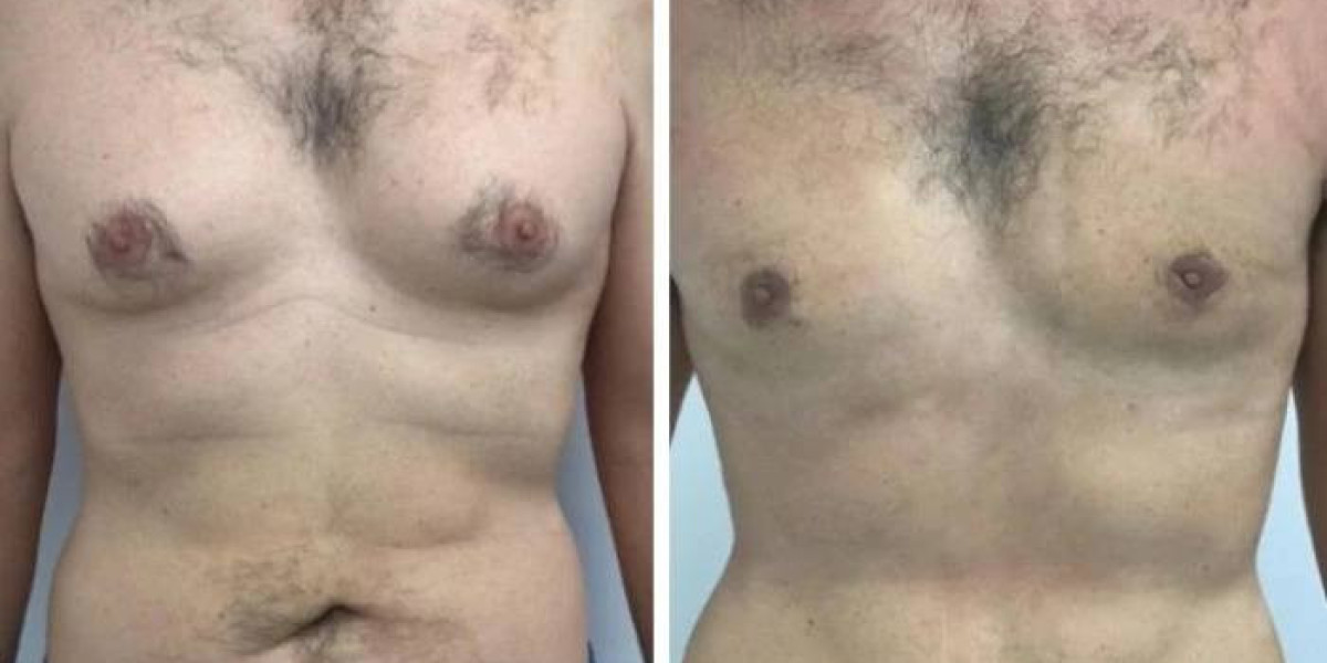 How to achieve Natural Results with Best Gynecomastia Surgeon in Dubai