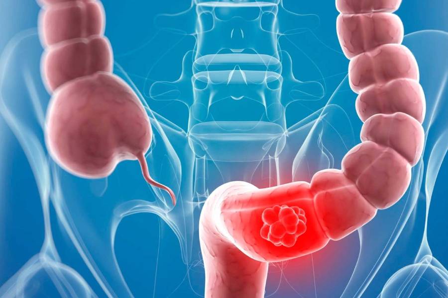 Advanced Colorectal Surgery in Hyderabad | Colorectal Surgeon in Secunderabad - Dr. N. S. Babu
