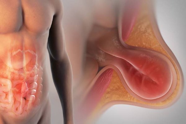Complex Hernia Treatment in Hyderabad | Dr. N. Subrahmaneswara Babu