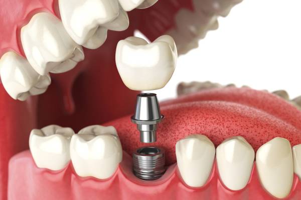 Best Dental Implant Treatment in Hinjewadi | Dr. Vikas Pakhare