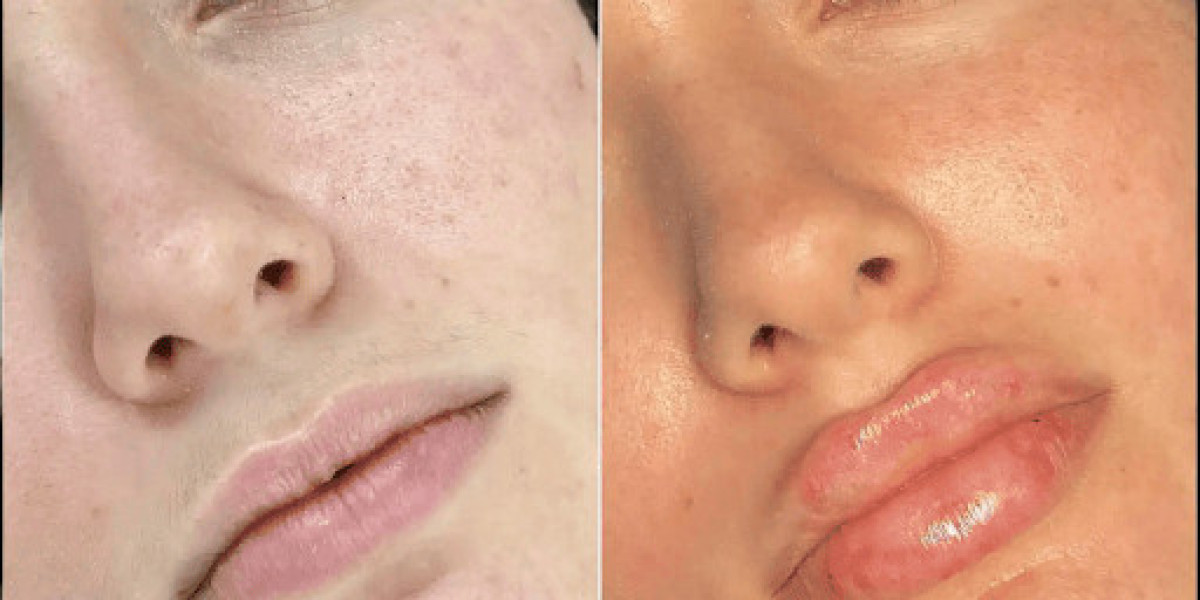 Best Plastic Surgeons in Dubai for Fillers for Long-Lasting Facial Rejuvenation