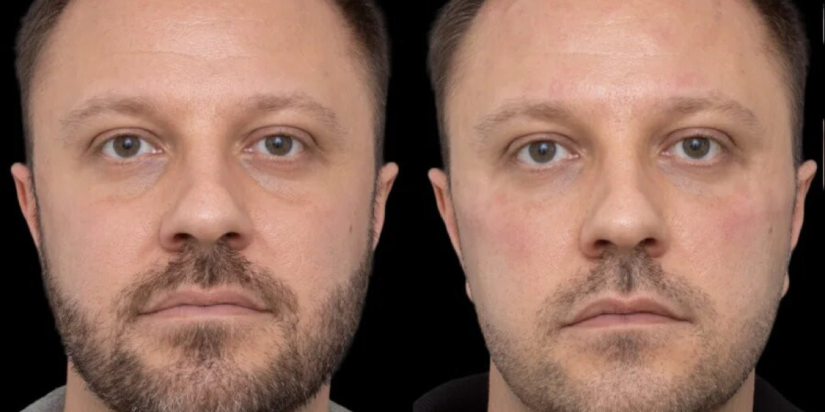 Best Practices for Long-Term Maintenance of Under Eye Fillers in Dubai